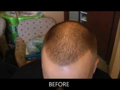 how to sleep after hair transplant