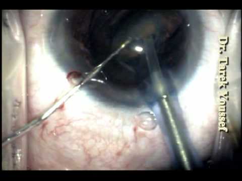 Toric IOL