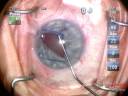 Malyugin ring insertion