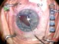 videos de Malyugin ring insertion