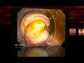 Colon Polyp Removal