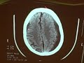 Subdural hematoma