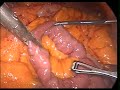 Dividing small bowel _gastric bypass