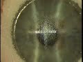 All Laser LASIK