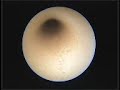 Kidney stone removal