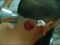 Cupping - Being Cupped / Blood Letting