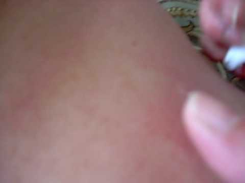 Huge Zit Finally Gets Popped!