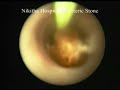 Urinary Stones in Bladder