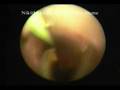 Urinary Stones in Bladder Ureter Kidney / Renal URS Video
