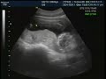 14 weeks baby!! ultrasound