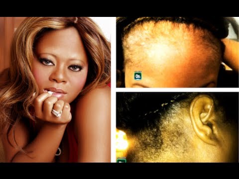 Countess Vaughn WARNS black woman about wearing lace front wigs she says they runined her hairline