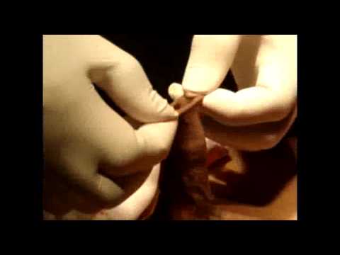 adult circumcision - Disposable Circumcision Device.