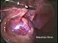 Esse vídeo demonstra a realização de ovário-histerectomia NOTES híbrida em uma cadela, utilizando endoscópio rígido de 5 mm pelo acesso abdominal. O procedimento está sendo desenvolvido e testado pelo autor desde junho de 2007. A técnica está em fase experimental, e deve ser embasada cientificamente antes de sua indicação para casos clínicos. O procedimento foi apresentado durante a palestra do autor intitulada: 