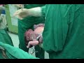 childbirth