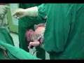 childbirth