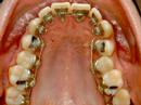 Orthosmile - iBraces 2