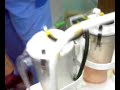 Suction
