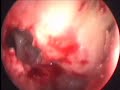 MIST- Minimally invasive Sinus Technique for isolated maxillary sinusitis where you dont widen natural ostia and prevent a stenosis at a later date, this is better than ballon sinuplasty and much cheaper and done under LA.
