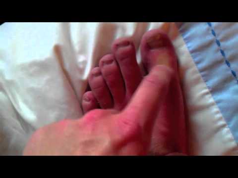 how to cure erythromelalgia