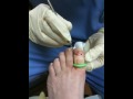 Performing a total matrixectomy of toenail. If you have found this educational video helpful please subscribe to my blog www.thefootandankleguide.blogspot.com