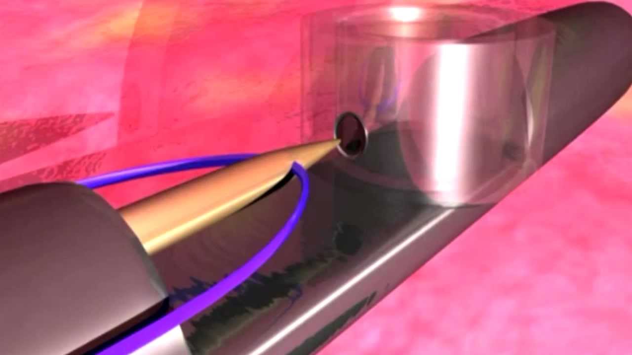 Dr. Wulc Explains the Wnaturallift™