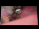 hopeless teeth decay withe severe tartar buildup