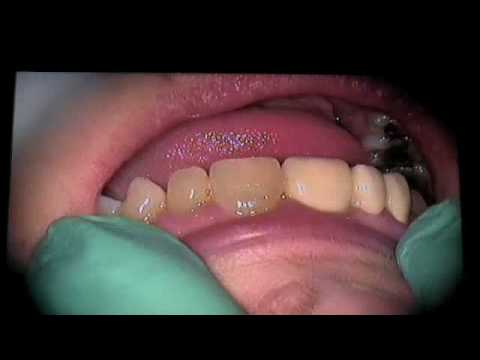 how to fix tooth decay