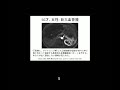 ???????giant cavernous hepatic hemangioma