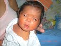 SHEBA MARITHE... Achondroplasia Baby SHEBA MARITHE... Achondroplasia Baby
