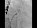 Amplatzer Cardiac Plug