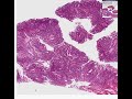 Histopathology Small intestine, duodenum--Peutz-Jeghers poly Histopathology Small intestine, duodenum--Peutz-Jeghers poly