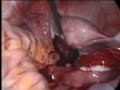 Laparoscopic Ovarian Cystectomy with intact cyst retrieval