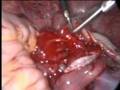 Laparoscopic Ovarian Cystectomy with intact cyst retrieval