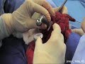 Total Scapula Prosthesis Ewing\