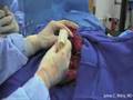Prosthesis Of Scapula Radical Removal Due To Sarcoma Of The Ewing - Part 6