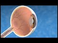 Diabetic Retinopathy....{A Complimentary from Rushabh Eye Hospital,India}
