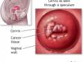 ortizchavez hpv
