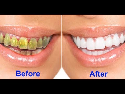 how to whiten your own teeth at home