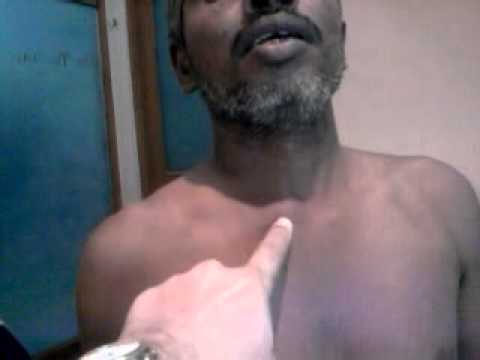 clavicular - this video shows a relatively uncommon conditionl in this case the dislocation occurs to the front (anterior); if it occurs toward the back (posterior) that ...