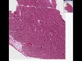 Histopathology Heart--Diphtheria