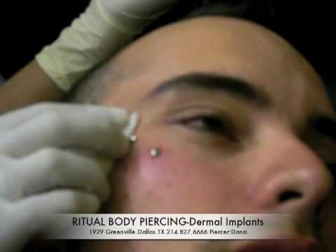 Dermal Anchor Implants@Ritual Body Piercing, Dallas, TX