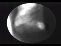 le poumon gauche a une grosse masse blanche et ronde !!qu'est-ce que c'est?the left lung has a large white round mass !! what is it?
