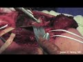 Distal Humerus Giant Cell Tumor Resection-Part 4