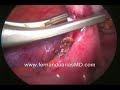 LAPAROSCOPIC APPENDECTOMY