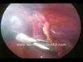 LAPAROSCOPIC APPENDECTOMY