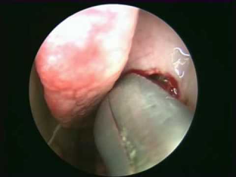 meatus