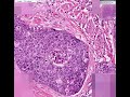Histopathology Cervix --Squamous cell carcinoma