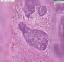 Histopathology Cervix --Squamous cell carcinoma