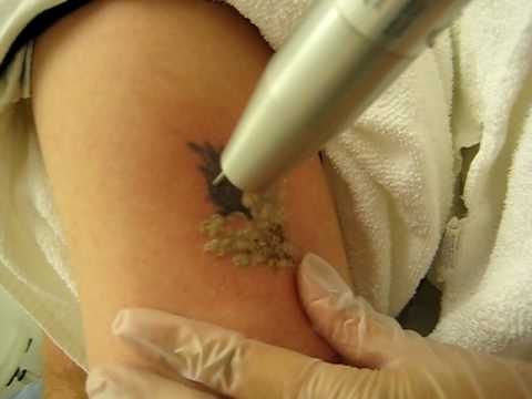 TATTOO REMOVAL IS PAINFUL!!! | Tatoos Body Jewelry