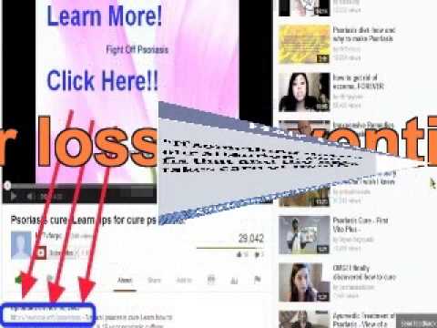 how to relieve oral allergy syndrome